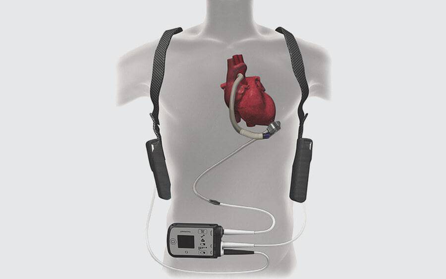 An image of the LVAD device connected to the heart in a body.