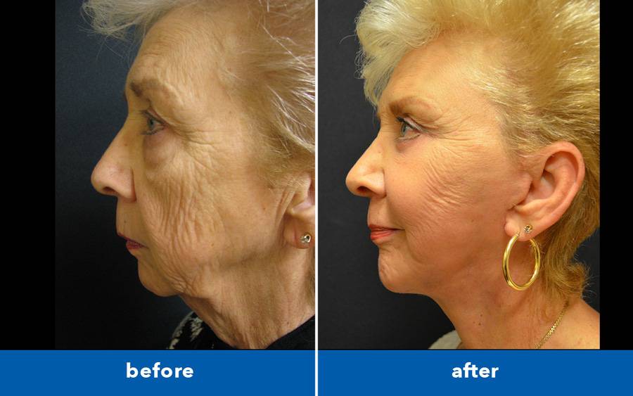 Older woman looks younger after plastic surgery to fix sagging neck skin.
