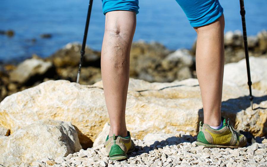 Varicose veins vs. spider veins. What's the difference?