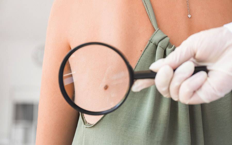 A noncancerous mole is being inspected by a doctor.