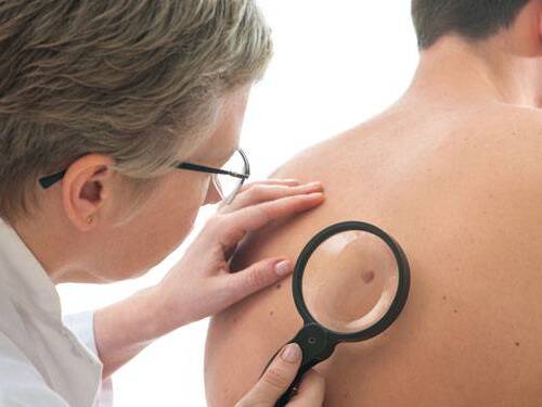 When to get screened for skin cancer and remove moles