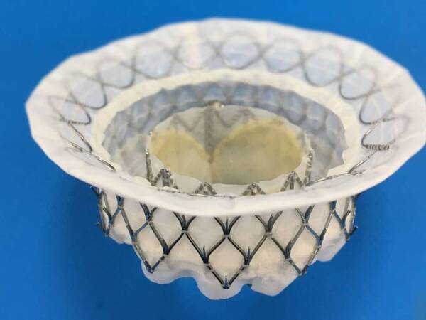 The Intrepid Transcatheter Mitral Valve Replacement (TMVR) System 1for treating mitral regurgitation. 
