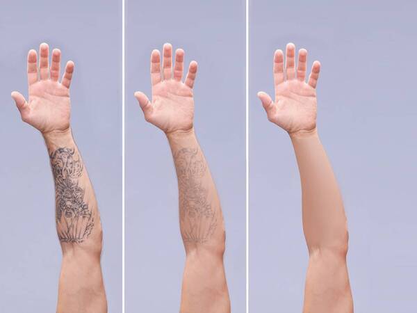 This series of three laser tattoo removal before and after photos shows how well tattoo ink can be removed from the skin using modern laser beams.