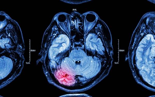 An image of the human brain, which was reviewed at the Scripps Brain Injury Conference that garnered media attention.