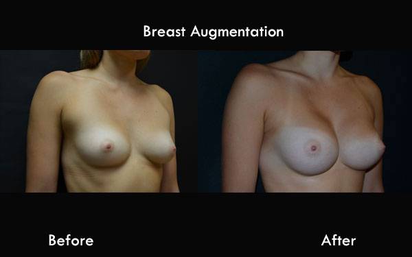 Clinic Plastic Surgery Breast Augmentation 600×375