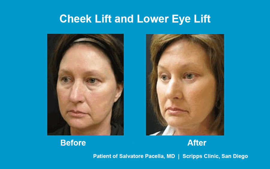 This before and after photo shows a woman's beautiful results after cheek lift and lower eye lift by Dr. Pacella of Scripps Clinic.