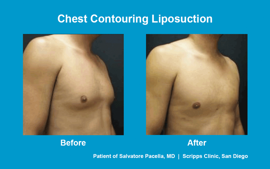 This before and after photo shows a man's sculpted results after chest contouring by Dr. Pacella of Scripps Clinic.