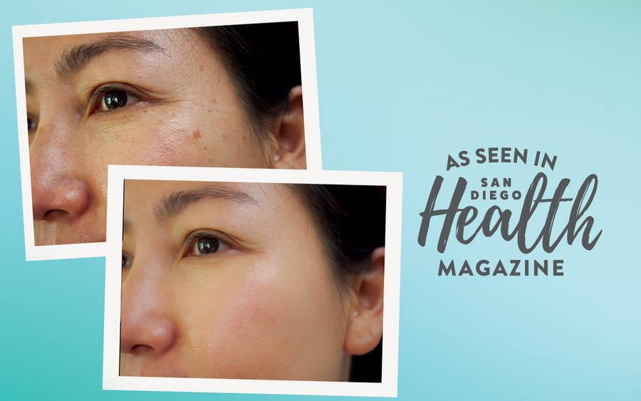 Before and after photos to remove dark spots — technical name “lentigines” — resemble freckles and hormone-triggered melasma but are darker and do not fade with a lack of sun exposure.