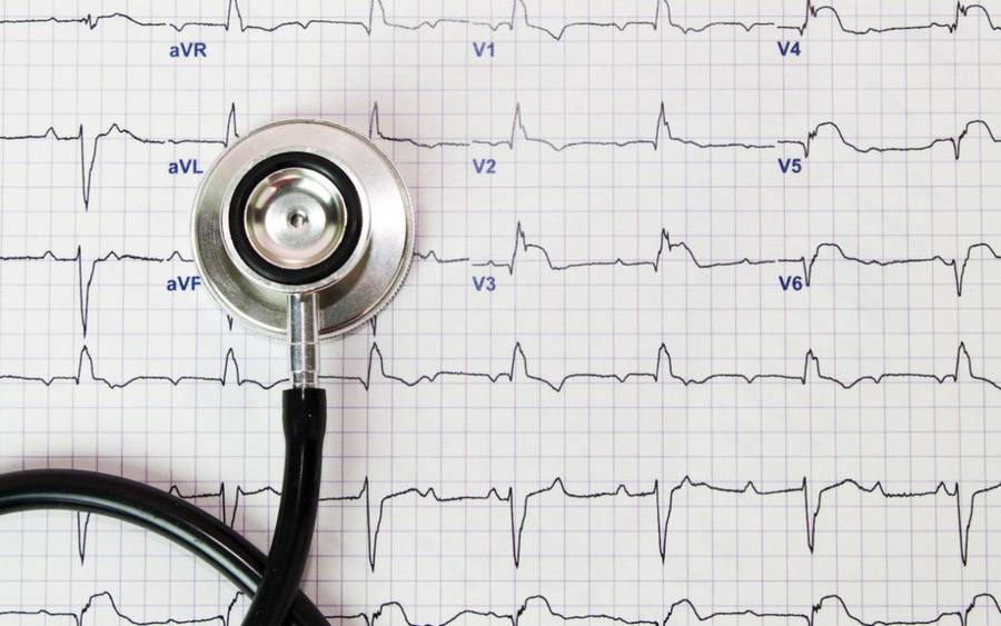 An EKG of AFib.