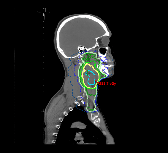 An ultrasound image revealed a lymph node measuring just under 6 centimeters.
