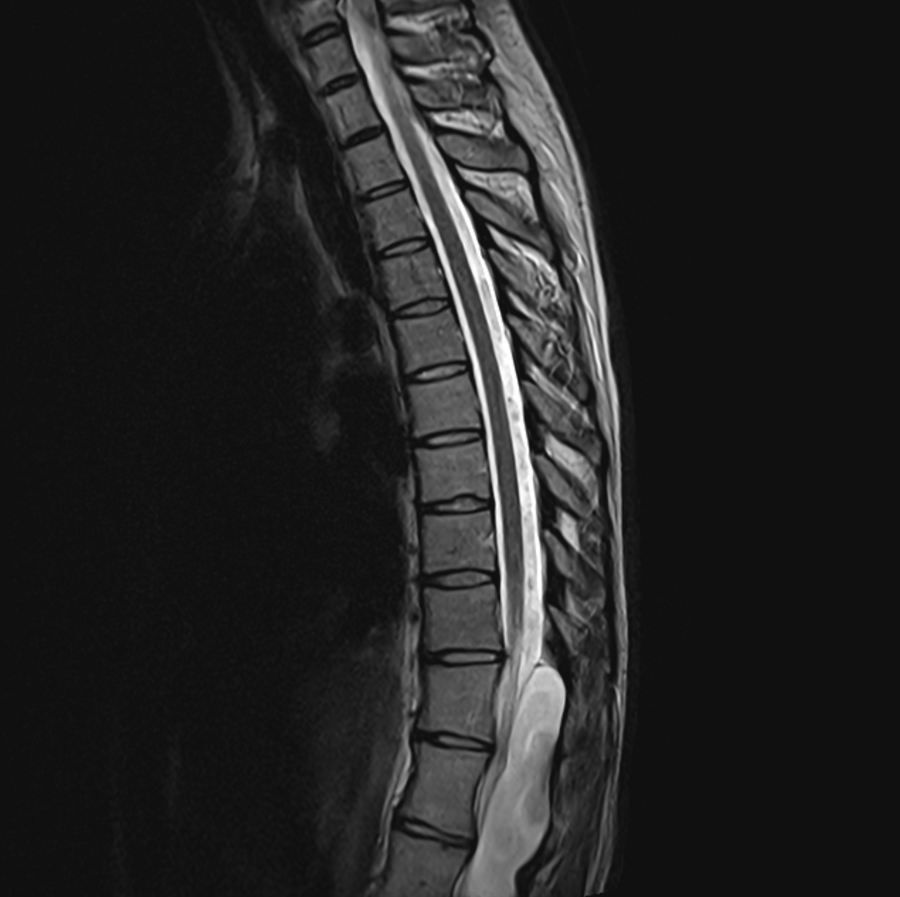 Spine scan