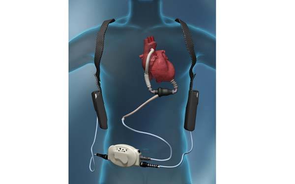 LVAD Information Session