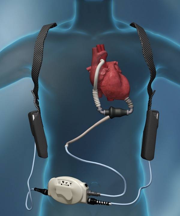 LVAD Diagram