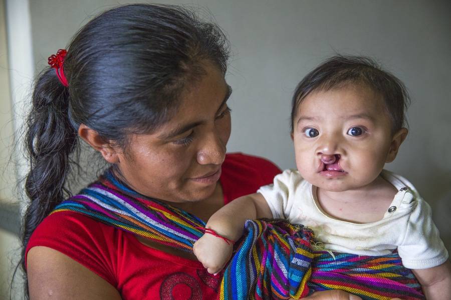 A mother gets help for her baby by Scripps Mercy Outreach Surgical Team in Mexico.