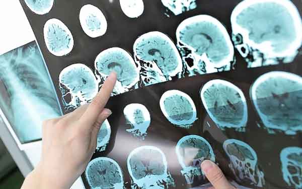 An imaging specialist reviews an image of the brain take from a police office who survived a stroke.