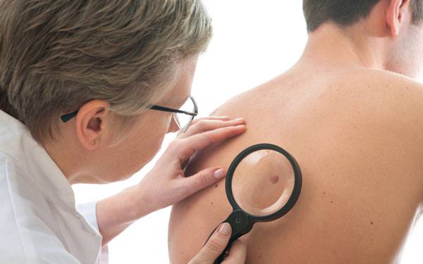When to get screened for skin cancer and remove moles