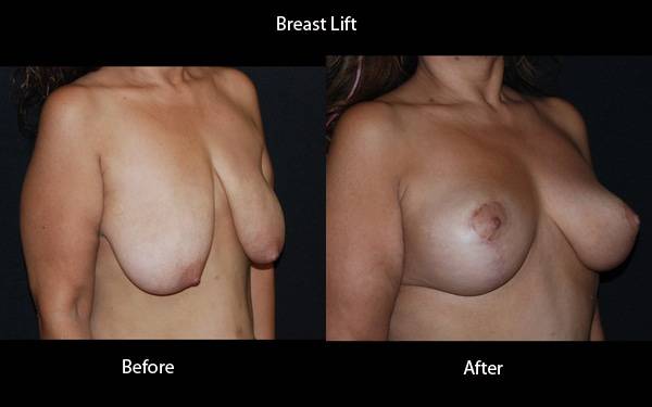 Clinic – Breast Lift Side