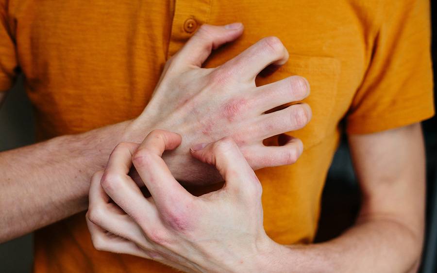 Man scratches hands full of rashes caused by stress.