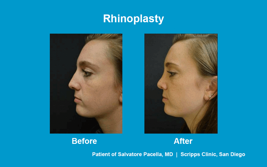 This before and after photo shows a young woman's beautiful results after rhinoplasty by Dr. Pacella of Scripps Clinic.