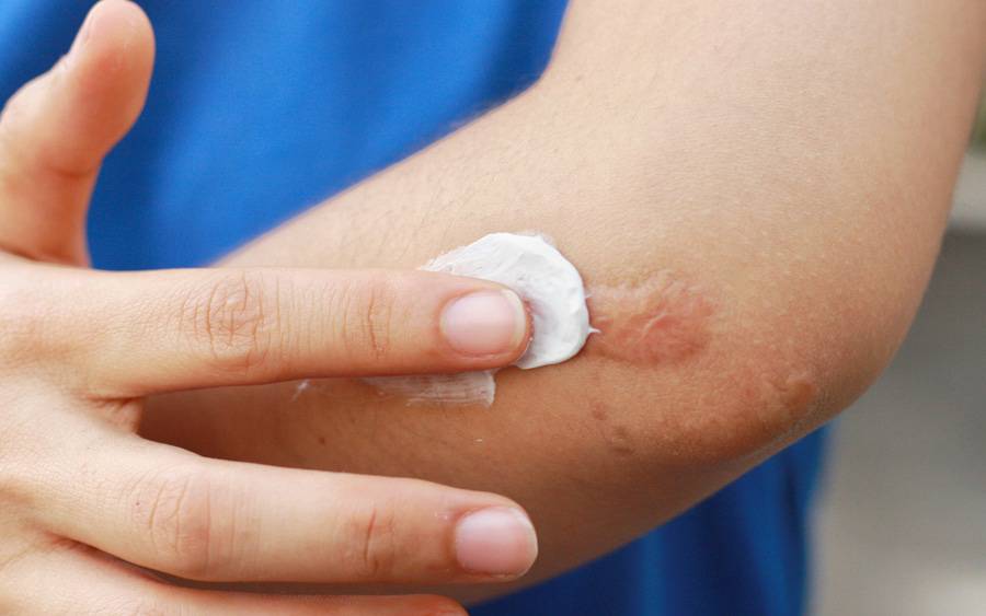 A person applies topical cream on a scar.