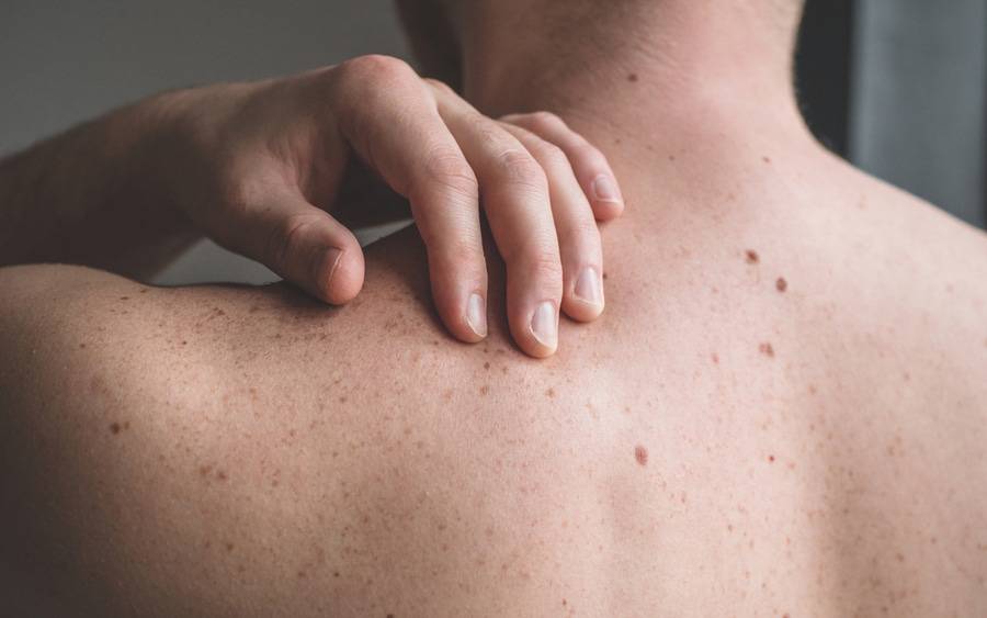 A woman shows with her hands small bumps on her back.