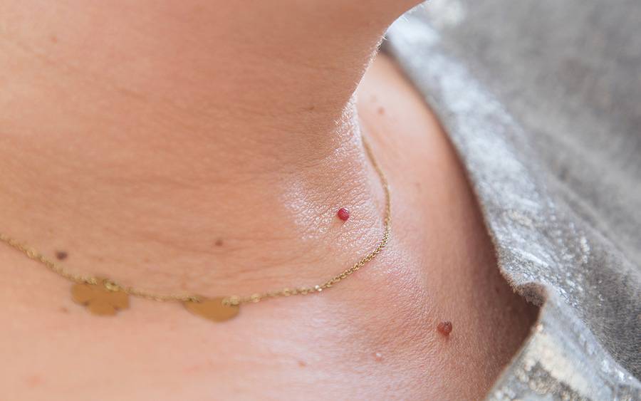 Woman's neck with skin tags.