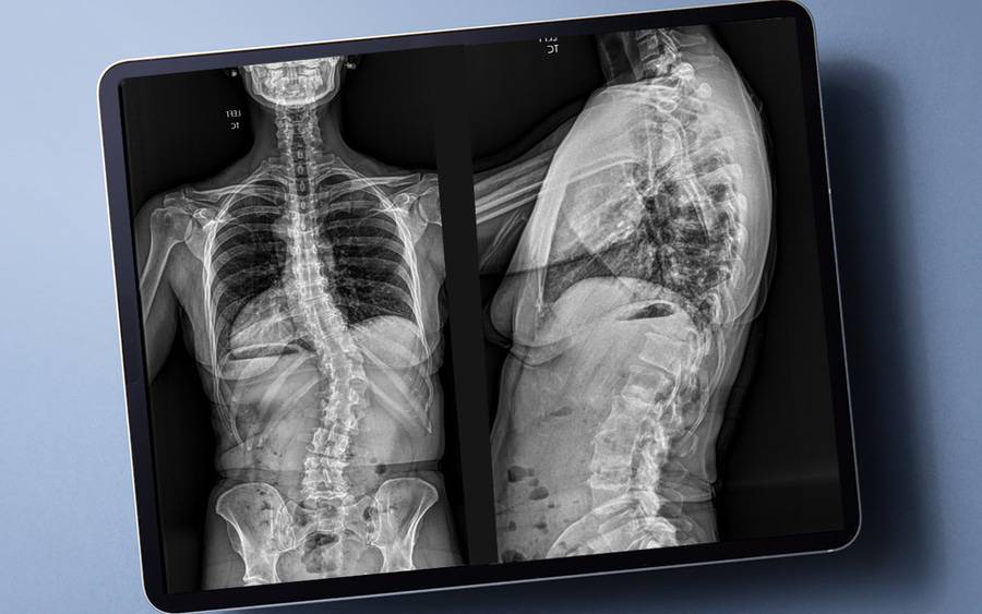 Advanced EOSedge imaging shows the front and side views of the spine with improved safety with less radiation.