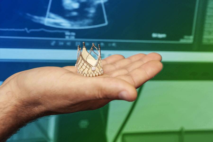 A physician holds a transcatheter aortic valve replacement (TAVR) in their hand.