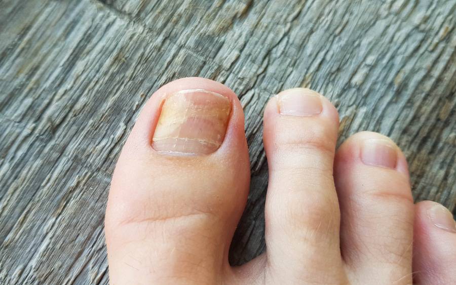 Nail Fungus Treatment available at the Triad Foot Center