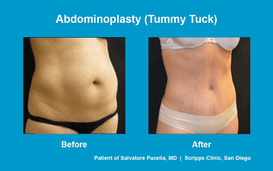This before and after photo shows a woman's toned results after a tummy tuck by Dr. Pacella of Scripps Clinic.