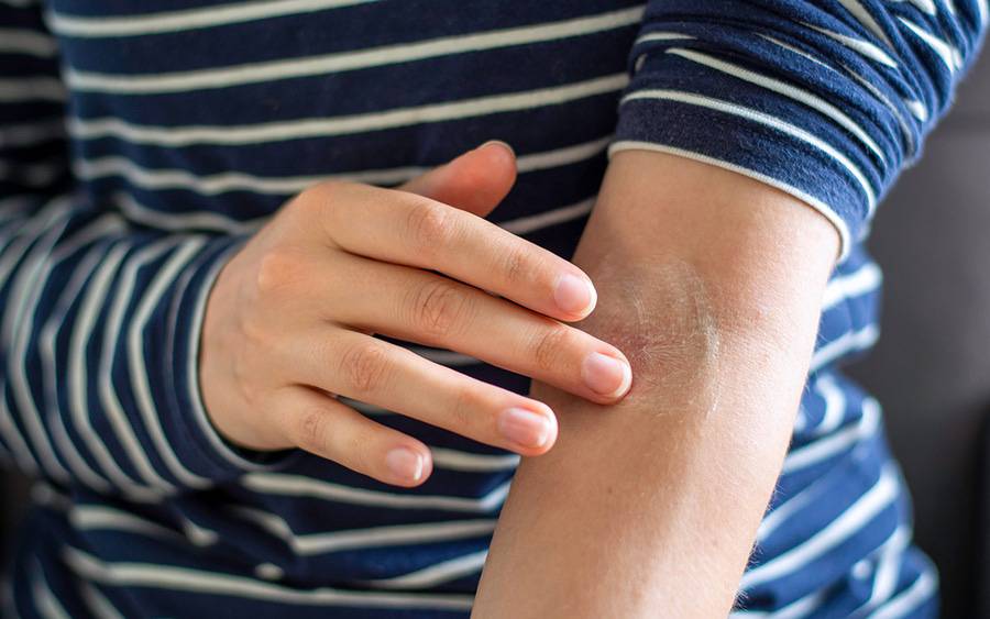 Young man shows white patches on his left arm.