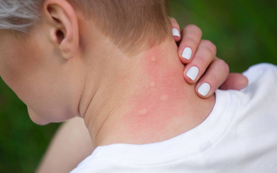 Woman shows effects of an insect sting on her neck.