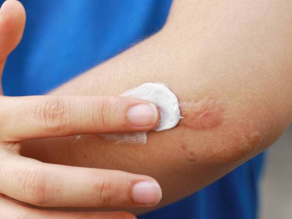 A person rubs a topical cream on a scar 1200X750