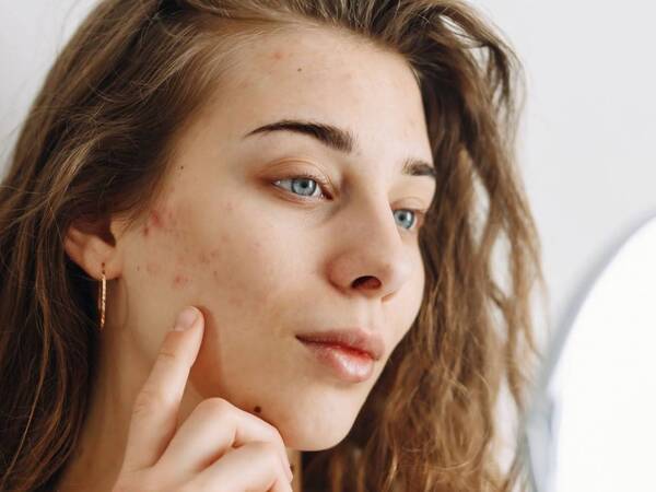 6 Acne Scar Treatments that Can Improve Your Skin