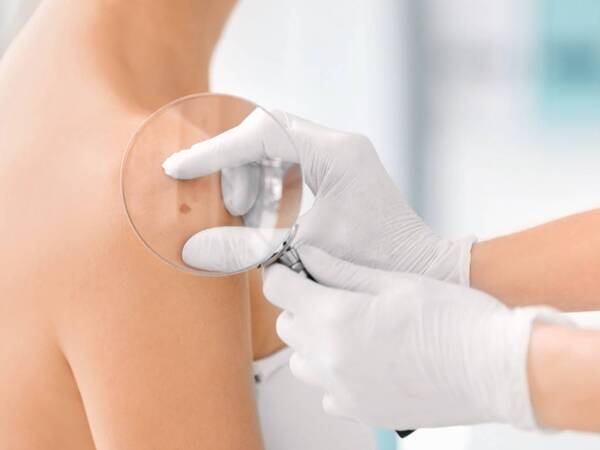 When Should I Get a Skin Cancer Screening?