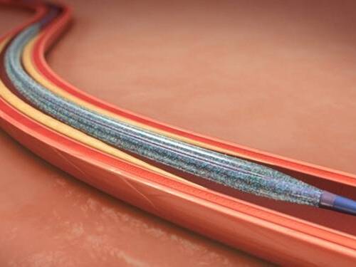 Scripps Offers New Treatment for Peripheral Artery Disease