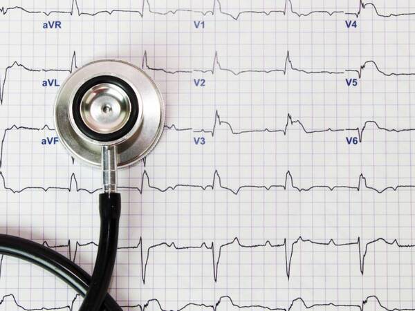 An EKG diagram of atrial fibrillation (AFib).