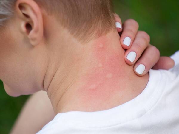 How Do You Treat Insect Bites and Stings?