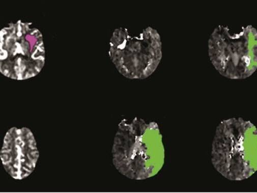 Scripps Neurologist Discusses Medical Advances Helping Stroke Patients