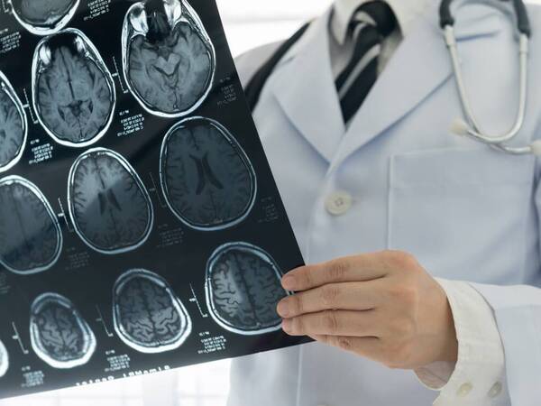 A doctor shows imaging of a brain stroke.