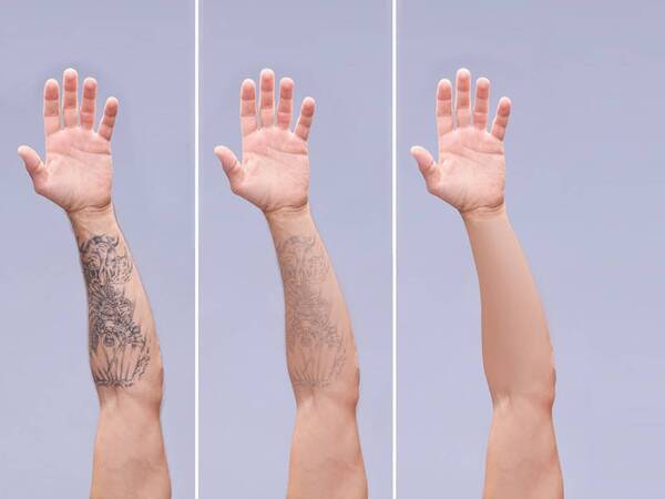 How Tattoo Removal Works - Scripps Health How Tattoo Removal Works - Scripps Health