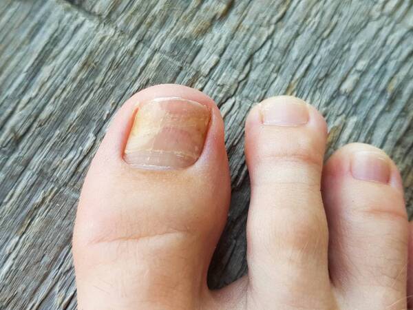 How to Treat Toenail Fungus