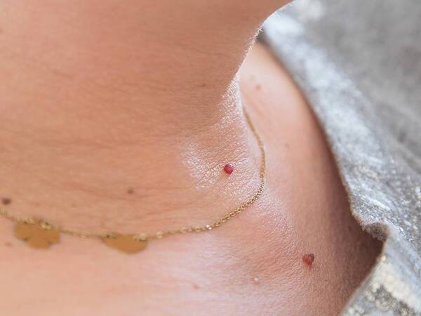 Skin tag