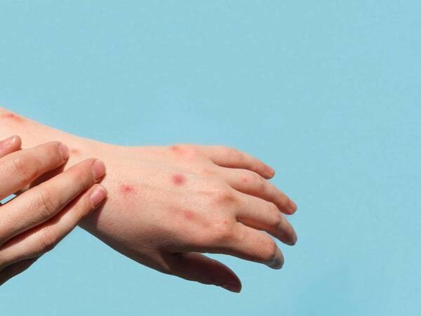 What Is Monkeypox? Should I Be Worried?