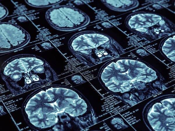 Advanced digital images of the brain and spine help the Scripps neurological team provide personalized care to every patient.