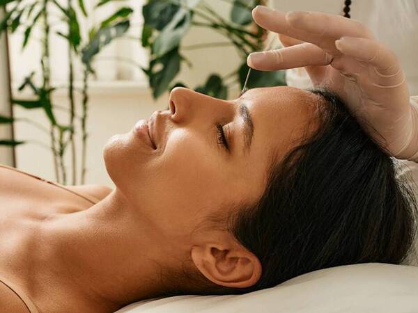 A woman rests comfortably as an acupuncture provider presses a needle into her forehead to relieve migraine pain.