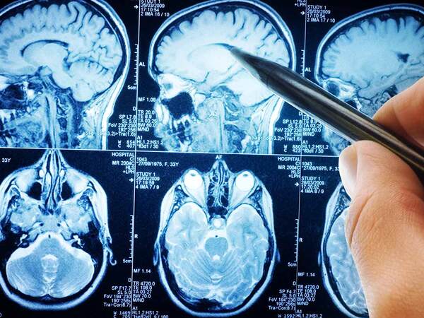 A person points to a brain scan, representing the quality data for the stroke program at Scripps.