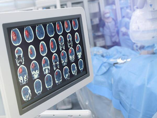 A computer screen shows brain scan images, representing the high-tech approach to neurosurgery at Scripps.