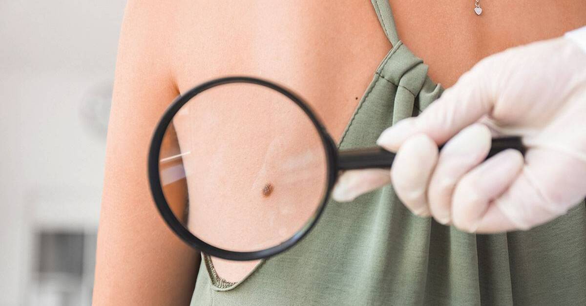How to know that are your mole benign or malignant?